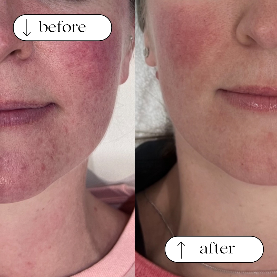 Before and after — real Dermaluxe client skin result