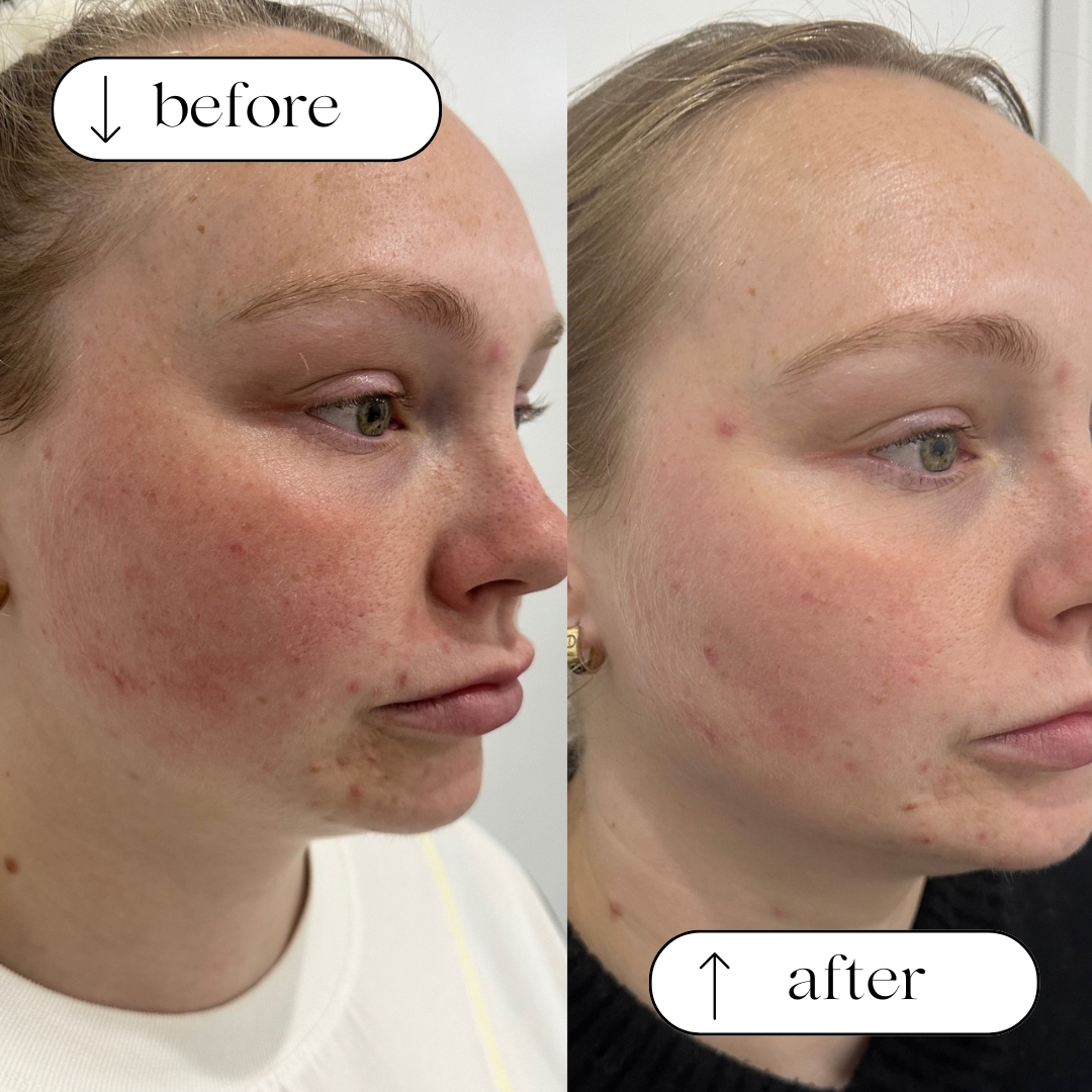 Before and after — real Dermaluxe client skin result